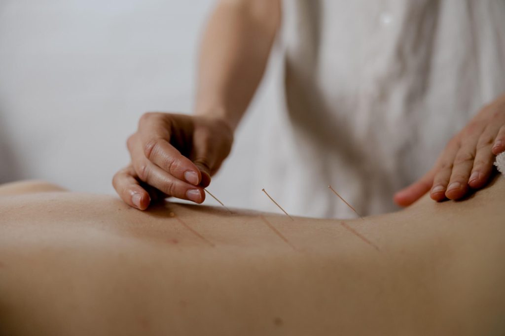 dry needling patient